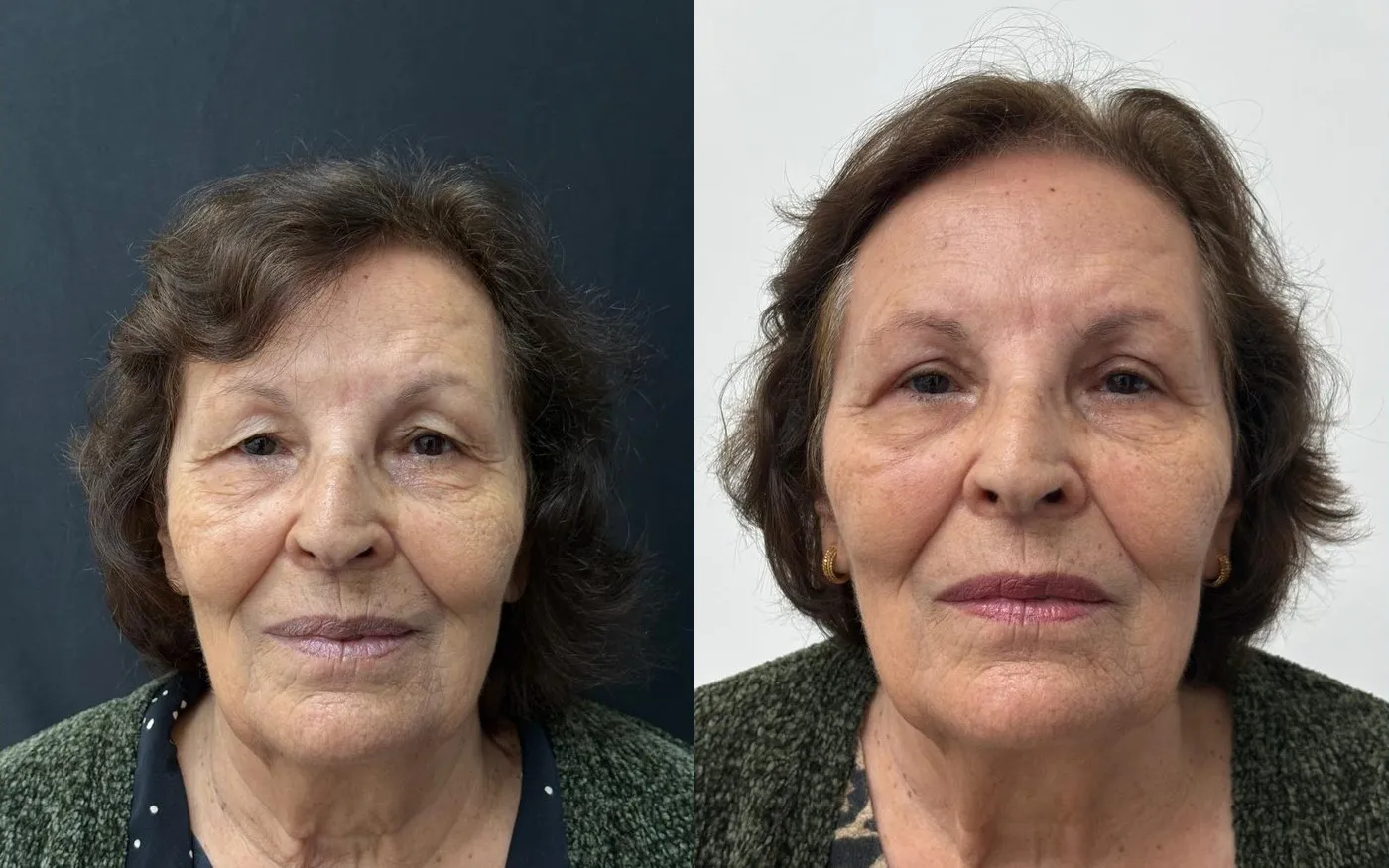 Blefaroplastia: foto de antes e depois de paciente real da Clínica Charmant (1)