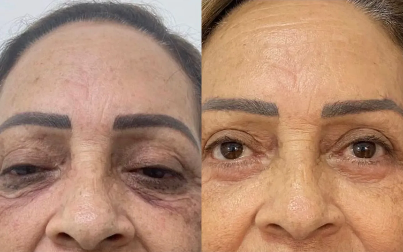 Blefaroplastia: foto de antes e depois de paciente real da Clínica Charmant (2)
