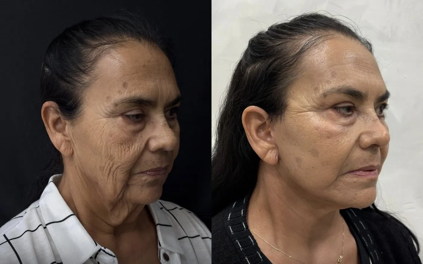 Facelift: foto de antes e depois de paciente real da Clínica Charmant (1)