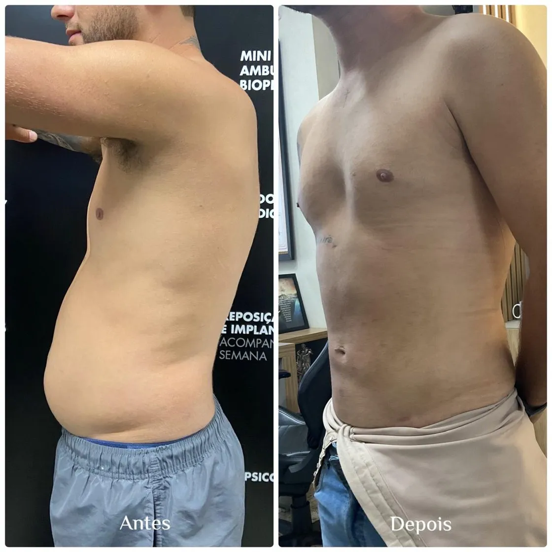Mini lipo com laser: foto de antes e depois de paciente real da Clínica Charmant (1)