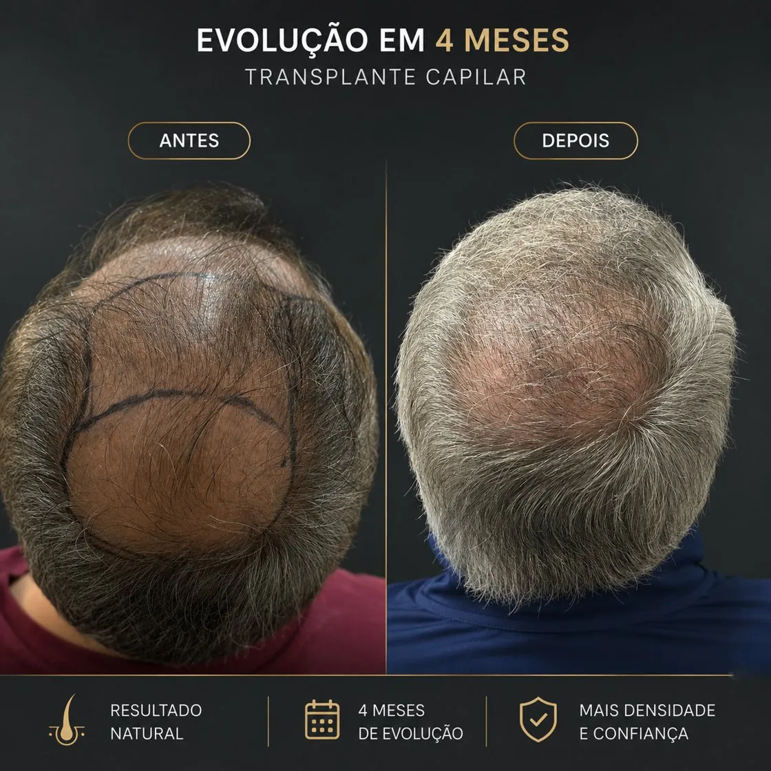 Transplante capilar: foto de antes e depois de paciente real da Clínica Charmant (2)